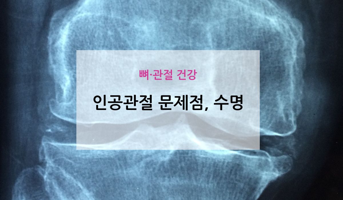 인공관절 문제점 수명