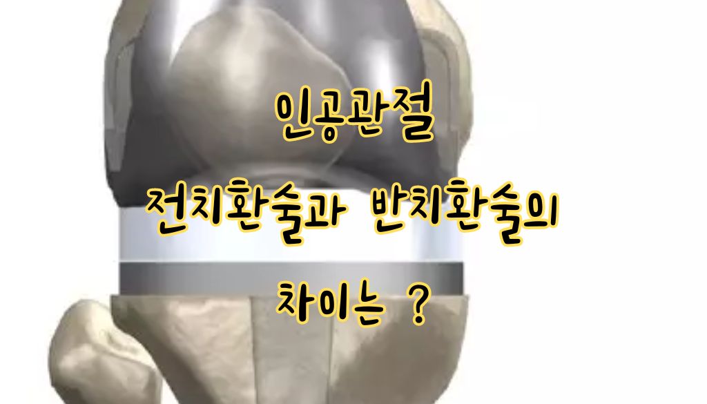 고관절 인공관절 수술