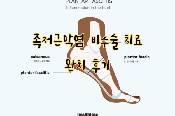 족저근막염 비수술 치료 완치 후기