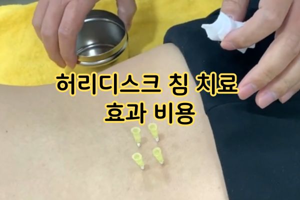 허리디스크 침 치료 효과 비용