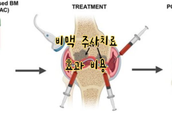 비맥 주사치료 효과 비용