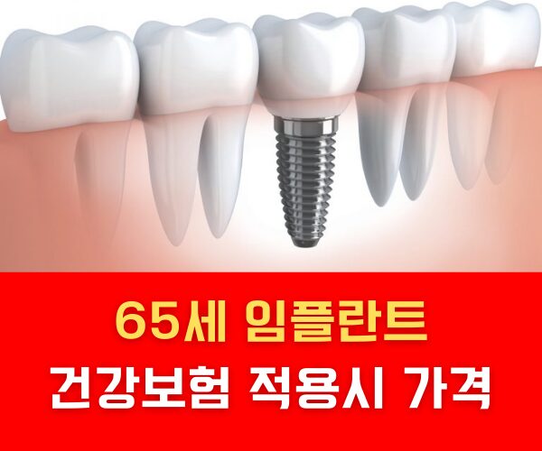 65세 임플란트 건강보험 적용 가격